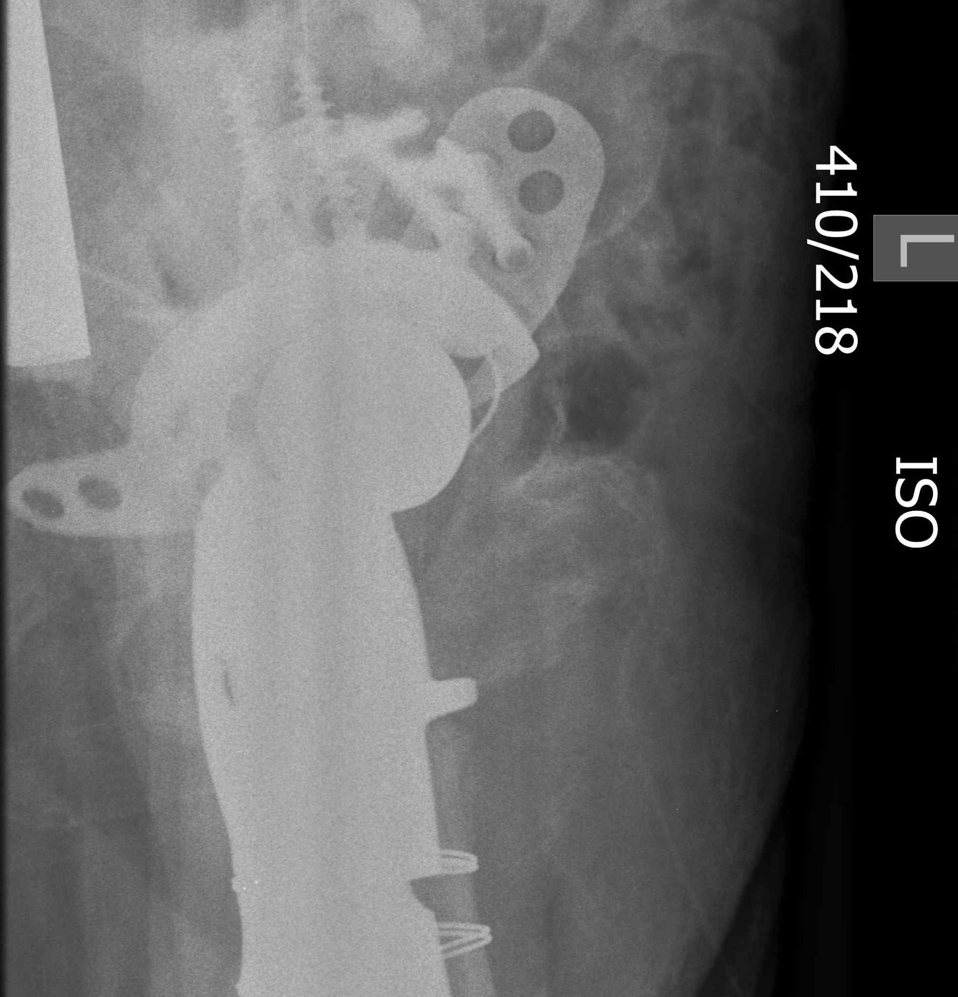 Bipolar Acetabular Destruction Revision 2